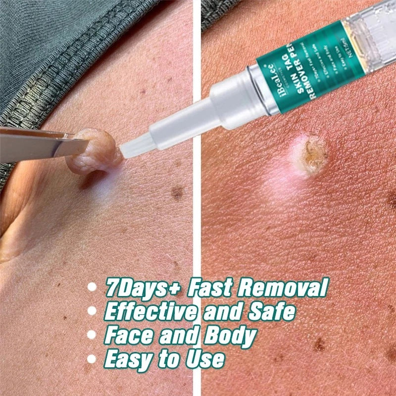 Wart Flat Especially AcutenessKe You Cream Smooth Liquid